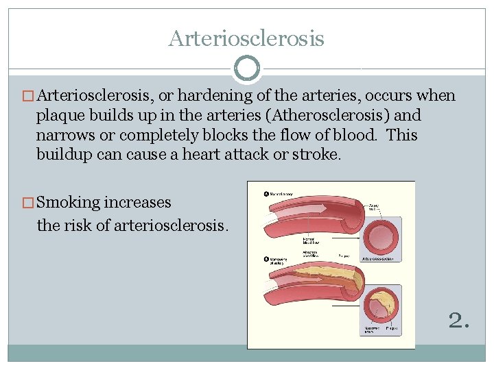 Arteriosclerosis � Arteriosclerosis, or hardening of the arteries, occurs when plaque builds up in