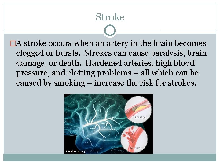 Stroke �A stroke occurs when an artery in the brain becomes clogged or bursts.