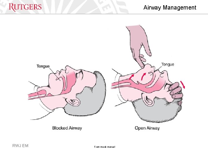 Airway Management RWJ EM From merck manual 