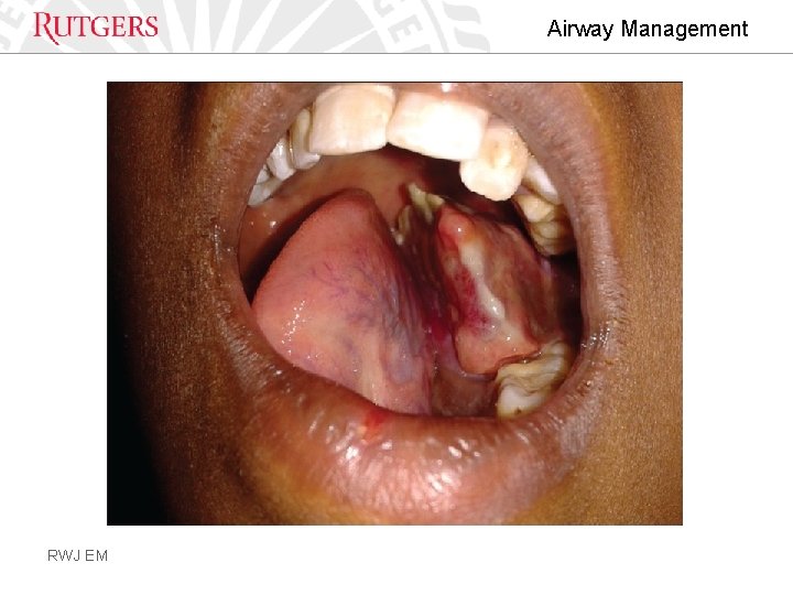 Airway Management RWJ EM 