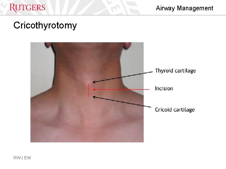 Airway Management Cricothyrotomy RWJ EM 