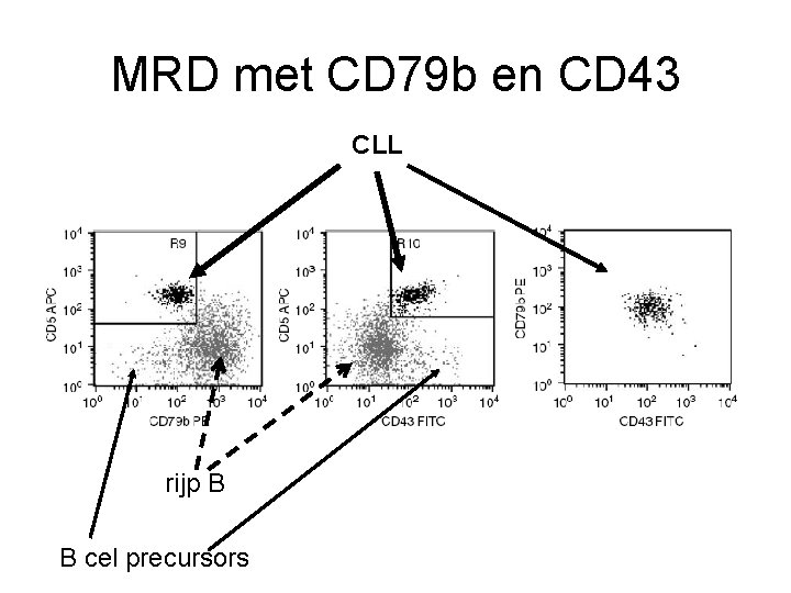 MRD met CD 79 b en CD 43 CLL rijp B B cel precursors