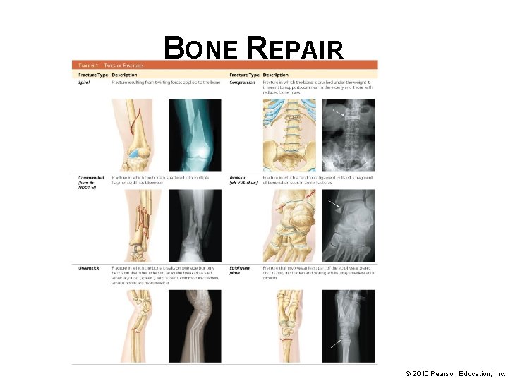 BONE REPAIR © 2016 Pearson Education, Inc. 