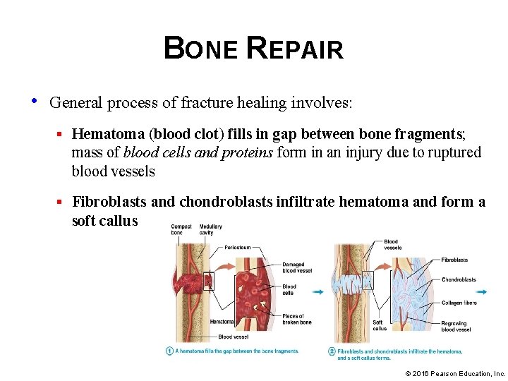BONE REPAIR • General process of fracture healing involves: § Hematoma (blood clot) fills