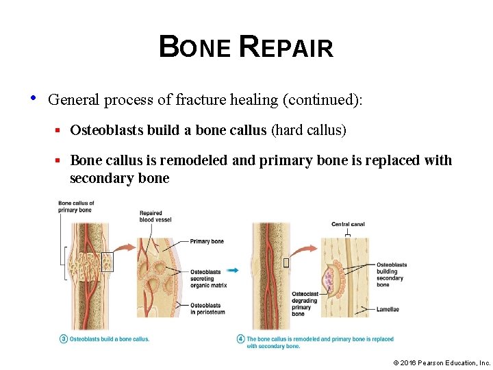BONE REPAIR • General process of fracture healing (continued): § Osteoblasts build a bone