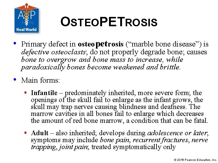 OSTEOPETROSIS • Primary defect in osteopetrosis (“marble bone disease”) is defective osteoclasts; do not