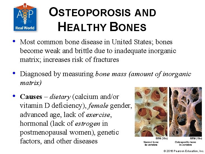 OSTEOPOROSIS AND HEALTHY BONES • Most common bone disease in United States; bones become