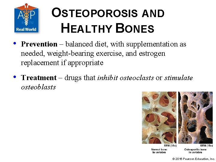 OSTEOPOROSIS AND HEALTHY BONES • Prevention – balanced diet, with supplementation as needed, weight-bearing