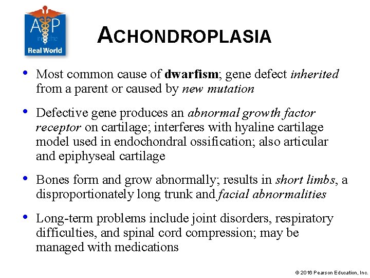 ACHONDROPLASIA • Most common cause of dwarfism; gene defect inherited from a parent or