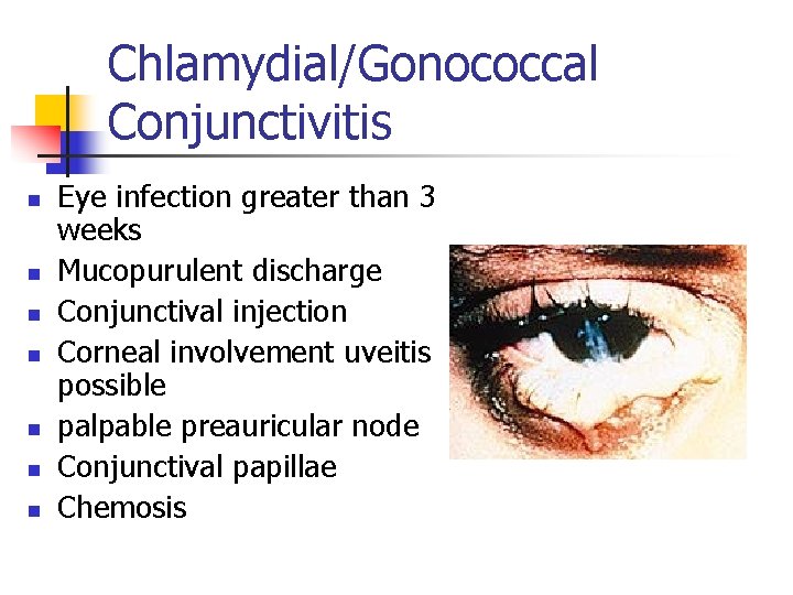 Chlamydial/Gonococcal Conjunctivitis n n n n Eye infection greater than 3 weeks Mucopurulent discharge