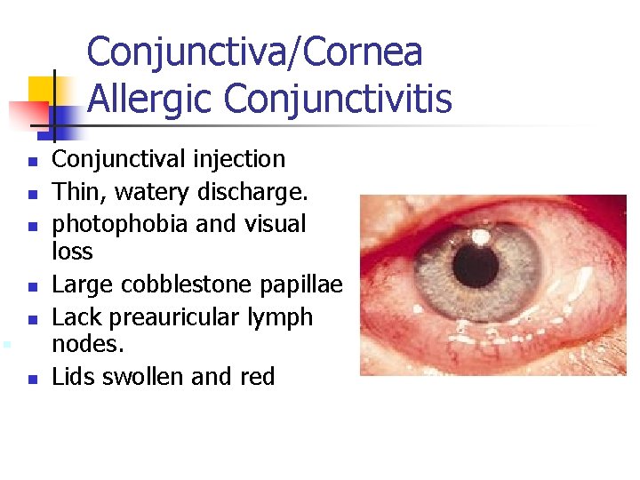 Conjunctiva/Cornea Allergic Conjunctivitis n n n n Conjunctival injection Thin, watery discharge. photophobia and