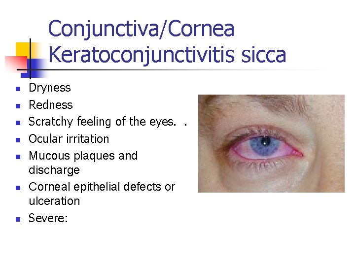 Conjunctiva/Cornea Keratoconjunctivitis sicca n n n n Dryness Redness Scratchy feeling of the eyes.