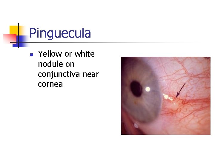 Pinguecula n Yellow or white nodule on conjunctiva near cornea 