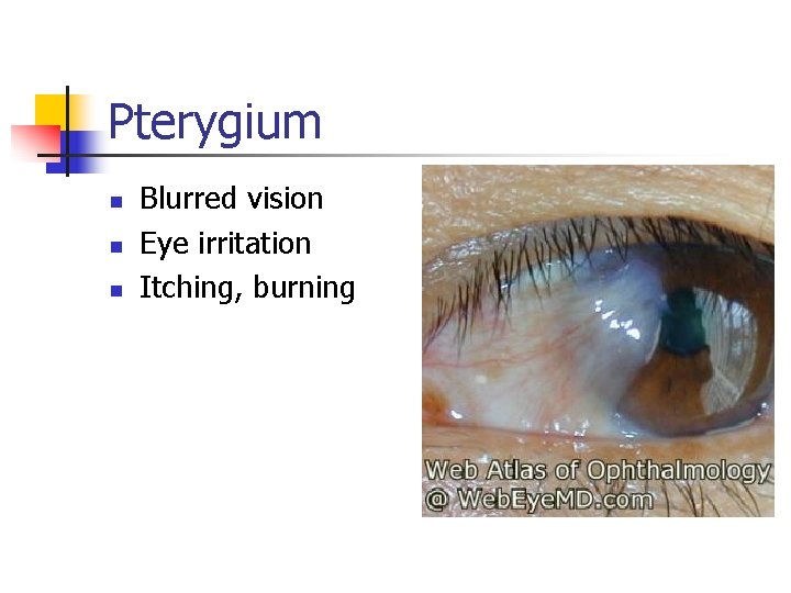 Pterygium n n n Blurred vision Eye irritation Itching, burning 