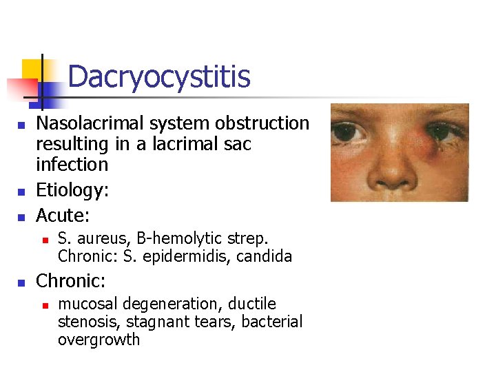 Dacryocystitis n n n Nasolacrimal system obstruction resulting in a lacrimal sac infection Etiology: