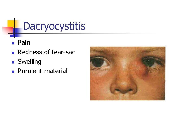 Dacryocystitis n n Pain Redness of tear-sac Swelling Purulent material 