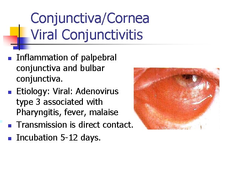 Conjunctiva/Cornea Viral Conjunctivitis n n Inflammation of palpebral conjunctiva and bulbar conjunctiva. Etiology: Viral: