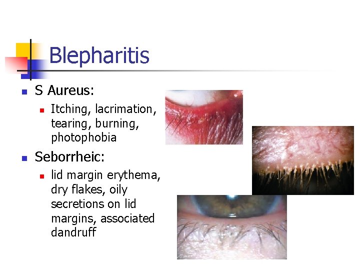 Blepharitis n S Aureus: n n Itching, lacrimation, tearing, burning, photophobia Seborrheic: n lid