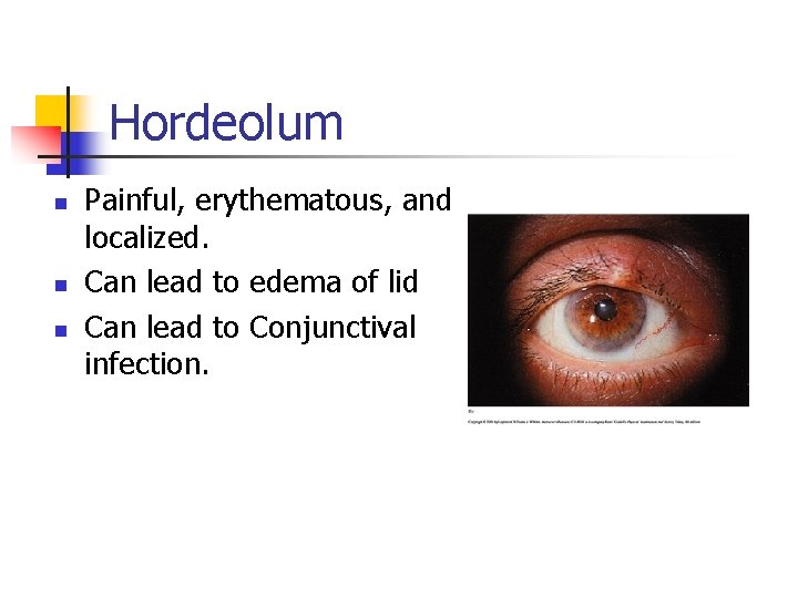 Hordeolum n n n Painful, erythematous, and localized. Can lead to edema of lid