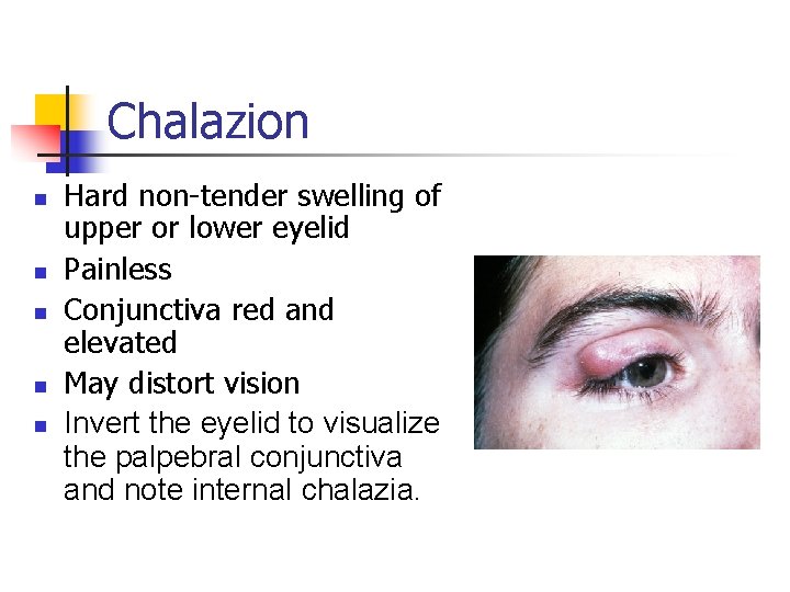 Chalazion n n Hard non-tender swelling of upper or lower eyelid Painless Conjunctiva red