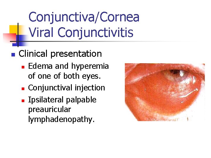 Conjunctiva/Cornea Viral Conjunctivitis n Clinical presentation n Edema and hyperemia of one of both