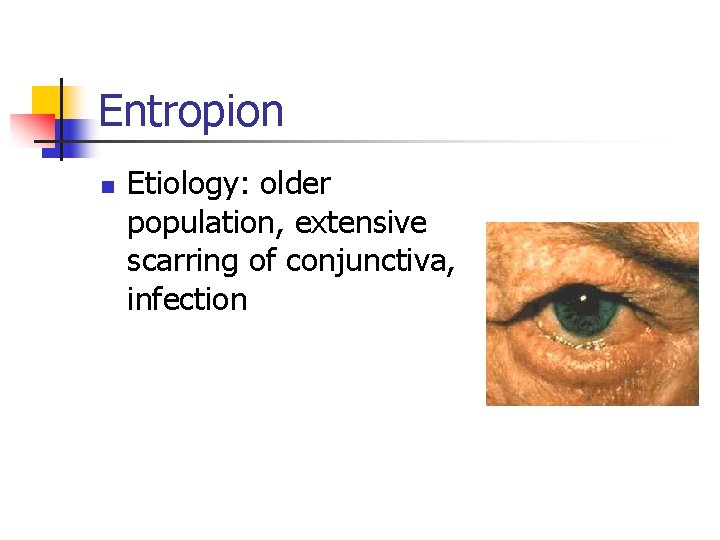 Entropion n Etiology: older population, extensive scarring of conjunctiva, infection 