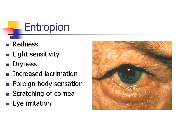 Entropion n n n Redness Light sensitivity Dryness Increased lacrimation Foreign body sensation Scratching