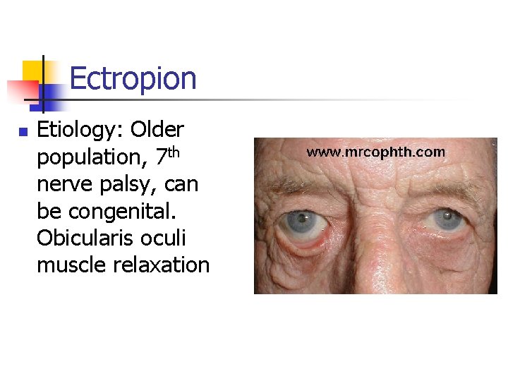 Ectropion n Etiology: Older population, 7 th nerve palsy, can be congenital. Obicularis oculi
