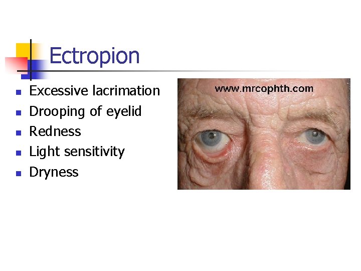 Ectropion n n Excessive lacrimation Drooping of eyelid Redness Light sensitivity Dryness 