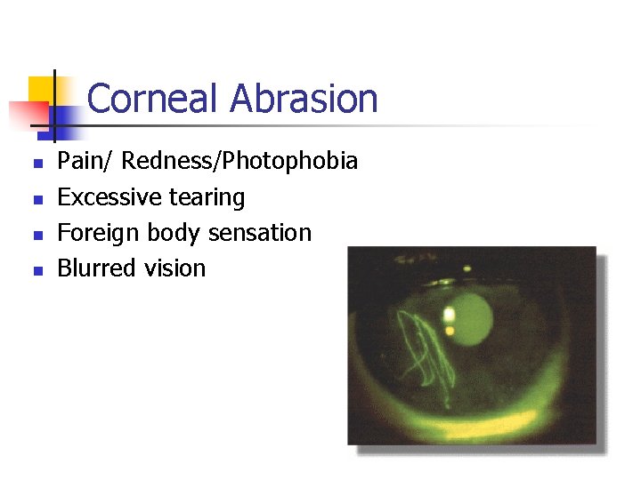 Corneal Abrasion n n Pain/ Redness/Photophobia Excessive tearing Foreign body sensation Blurred vision 