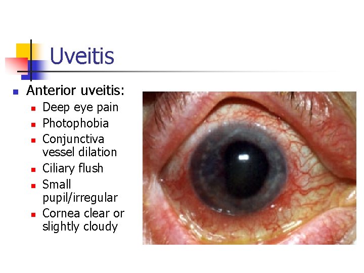 Uveitis n Anterior uveitis: n n n Deep eye pain Photophobia Conjunctiva vessel dilation