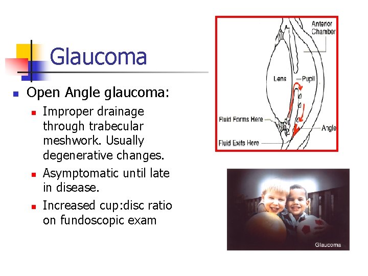 Glaucoma n Open Angle glaucoma: n n n Improper drainage through trabecular meshwork. Usually