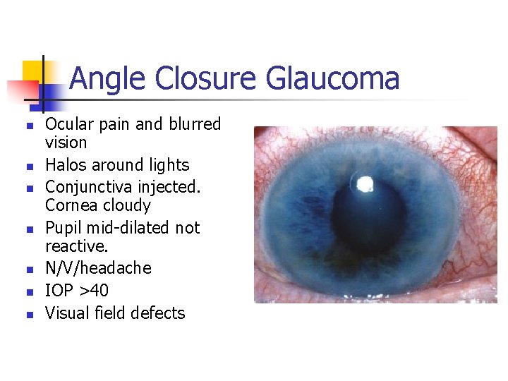 Angle Closure Glaucoma n n n n Ocular pain and blurred vision Halos around