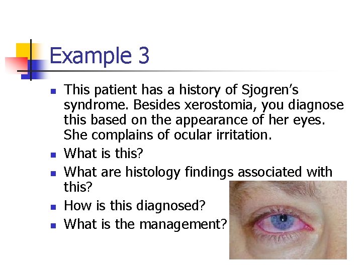 Example 3 n n n This patient has a history of Sjogren’s syndrome. Besides