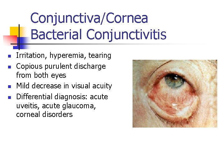 Conjunctiva/Cornea Bacterial Conjunctivitis n n Irritation, hyperemia, tearing Copious purulent discharge from both eyes