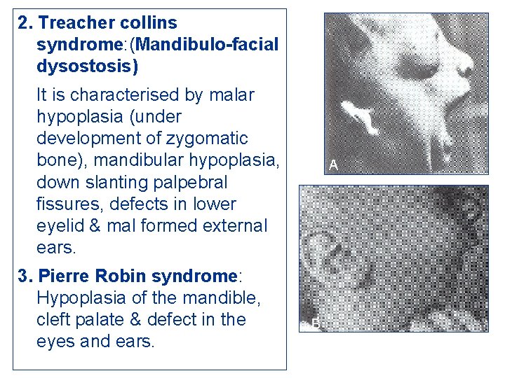 2. Treacher collins syndrome: (Mandibulo-facial dysostosis) It is characterised by malar hypoplasia (under development