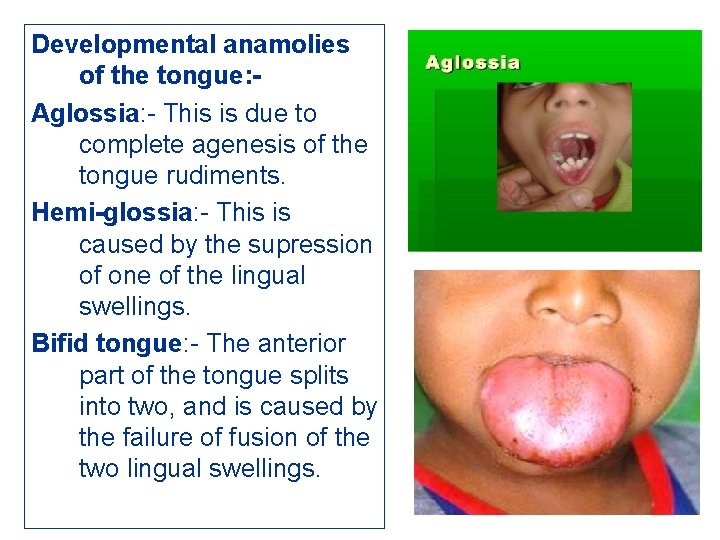 Developmental anamolies of the tongue: Aglossia: - This is due to complete agenesis of