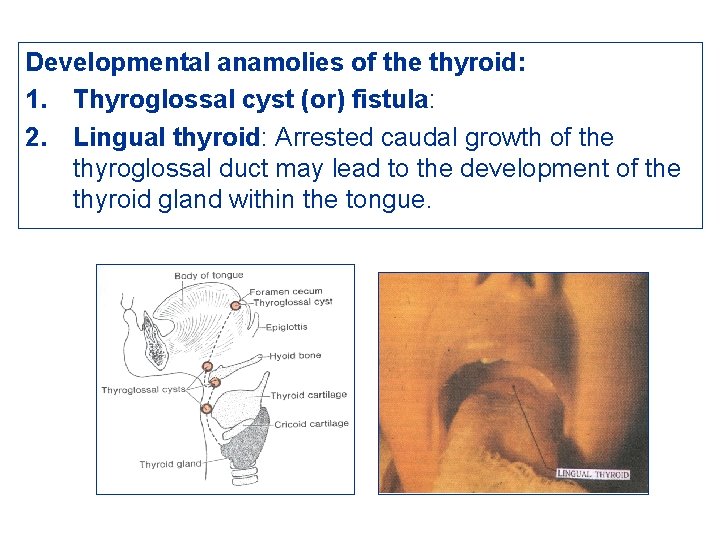 Developmental anamolies of the thyroid: 1. Thyroglossal cyst (or) fistula: 2. Lingual thyroid: Arrested