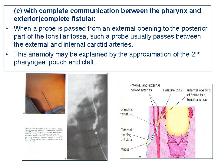(c) with complete communication between the pharynx and exterior(complete fistula): • When a probe