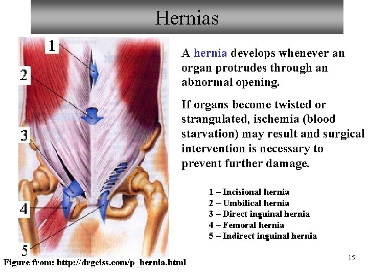 Hernias A hernia develops whenever an organ protrudes through an abnormal opening. If organs