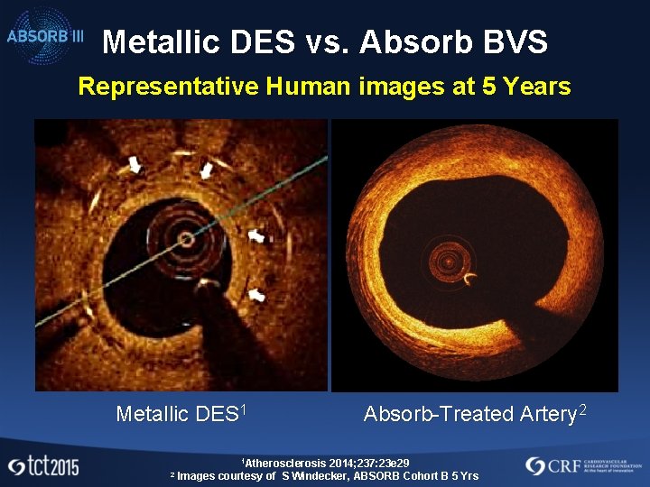 Metallic DES vs. Absorb BVS Representative Human images at 5 Years Metallic DES 1