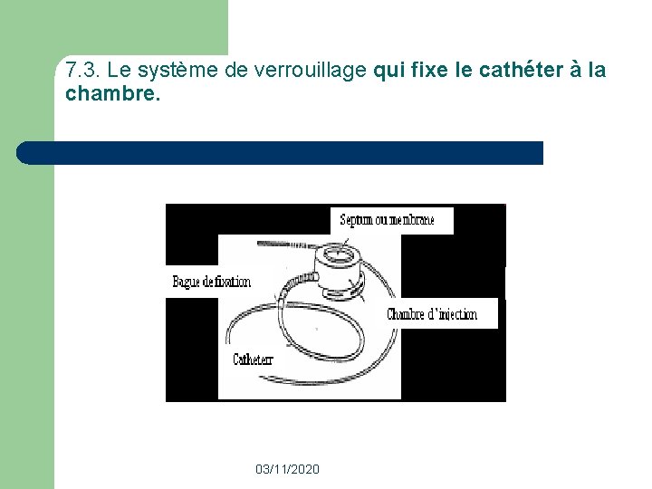 7. 3. Le système de verrouillage qui fixe le cathéter à la chambre. 03/11/2020