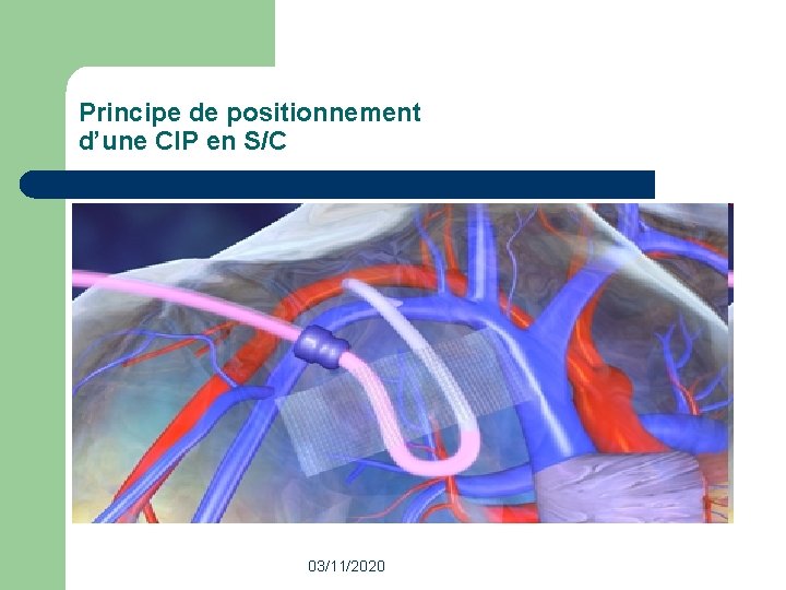Les Chambres implantables ou Accs vasculaire implantable Rle