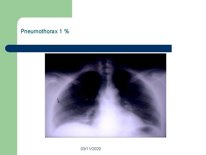 Pneumothorax 1 % 03/11/2020 