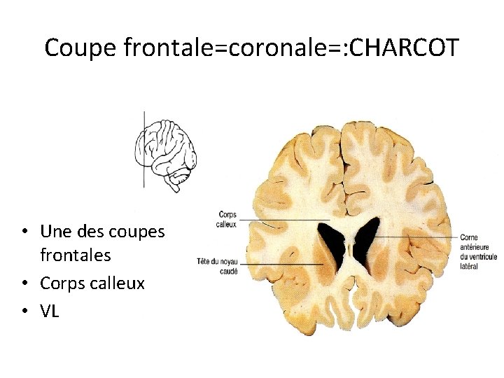 Coupe frontale=coronale=: CHARCOT • Une des coupes frontales • Corps calleux • VL 