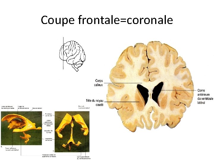 Coupe frontale=coronale 