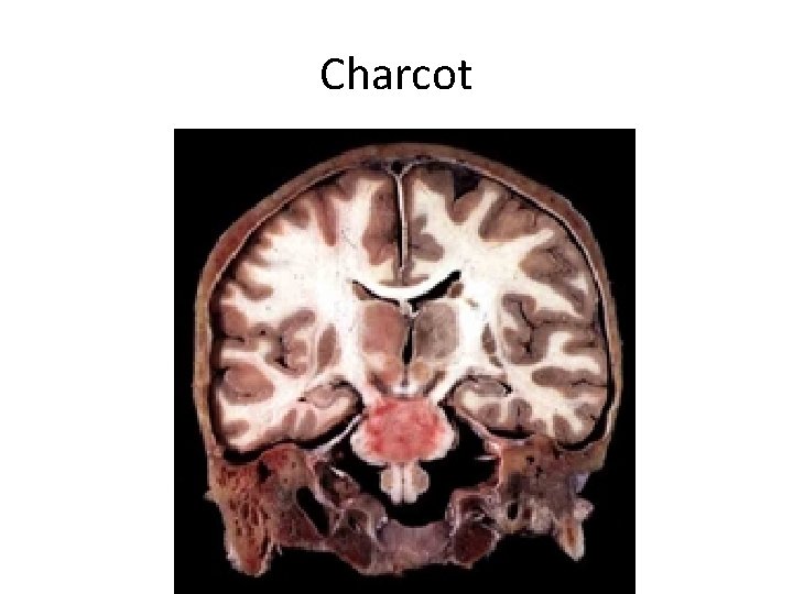 Charcot 