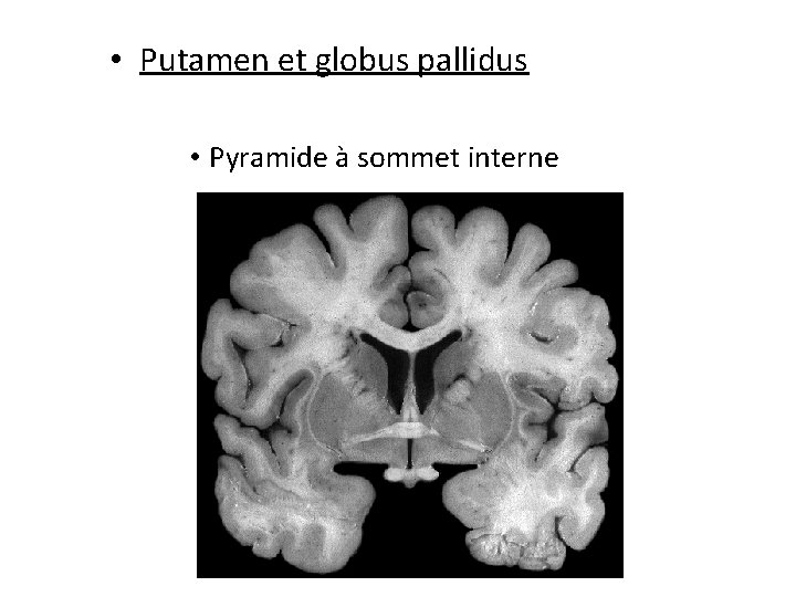  • Putamen et globus pallidus • Pyramide à sommet interne 