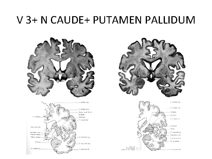 V 3+ N CAUDE+ PUTAMEN PALLIDUM 