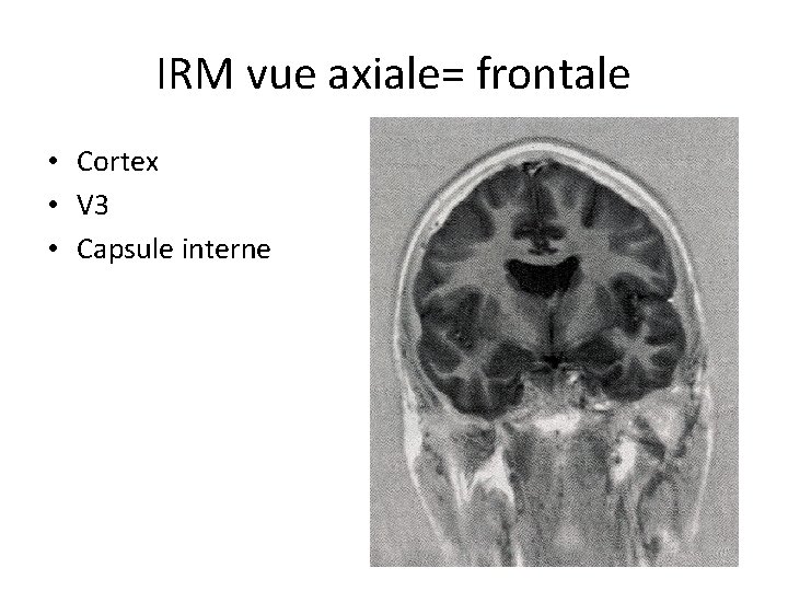 IRM vue axiale= frontale • Cortex • V 3 • Capsule interne 